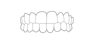 MORSO INVERSO - Quando i denti dell’arcata superiore non scavalcano quelli dell’arcata inferiore