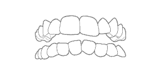 AFFOLLAMENTO DENTALE - Quando c’è una differenza tra le dimensioni dei denti e lo spazio necessario per il loro allineamento