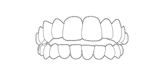 MORSO APERTO - Quando i denti anteriori dell’arcata superiore non toccano l’arcata inferiore