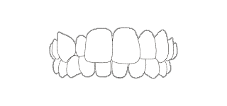 MORSO CROCIATO - Quando i denti dell’arcata superiore non scavalcano quelli dell’arcata inferiore