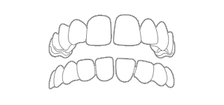 SPAZIO FRA DENTI - Quando un diastema causa uno spazio eccessivo tra un dente e l'altro