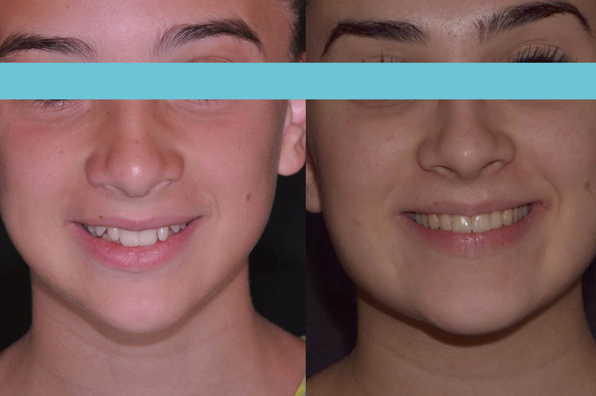 Il sorriso di Michela - Casi Clinici - Antonio Manni - Studio dentistico