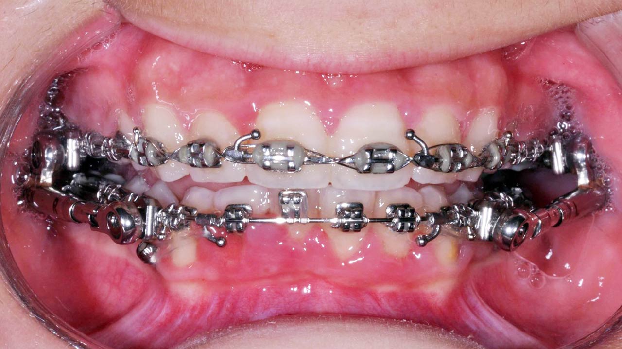 Avanzamento della mandibola per la correzione della II classe dentale - Casi Clinici - Antonio Manni - Studio dentistico